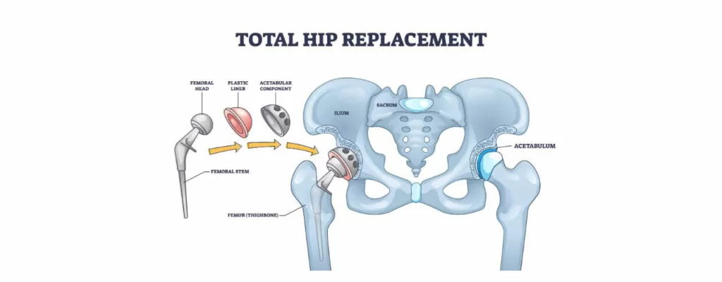 Hip replacement rehab in New Jersey